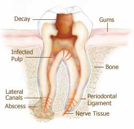 Painless Root Canals In Wayne NJ