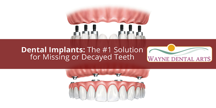 Dental Implants The Best Solution for Missing Teeth Dr Frank Maldonado